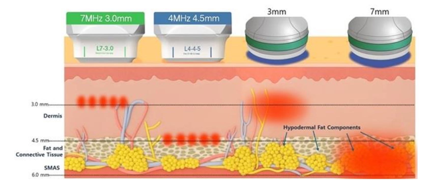 Microwave ONDA HIFU 埋線拉提治療層次比較